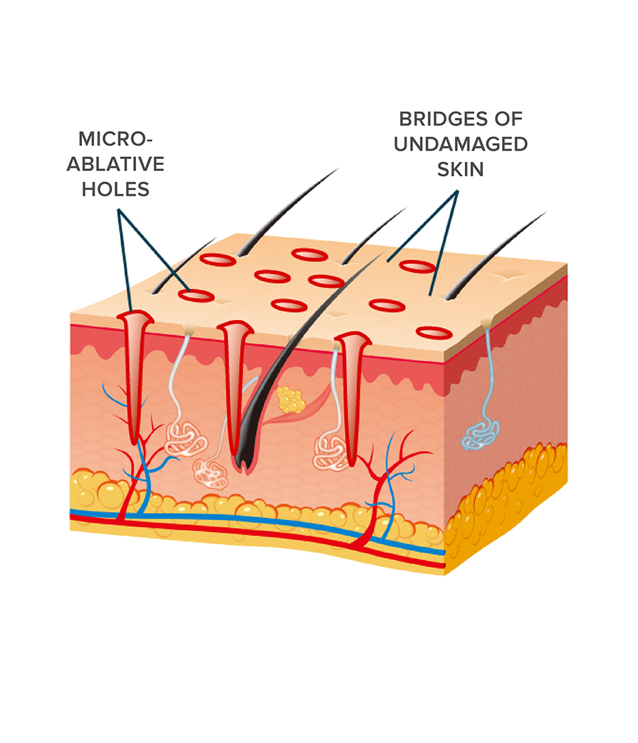 laser skin resurfacing results laser skin resurfacing results